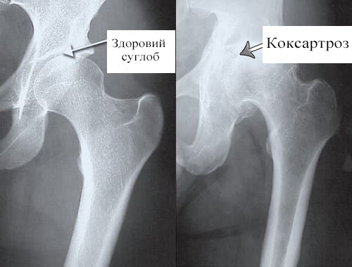 Рис 1. Здоровий суглоб (зліва) Рис. 2 Коксартроз (праворуч)