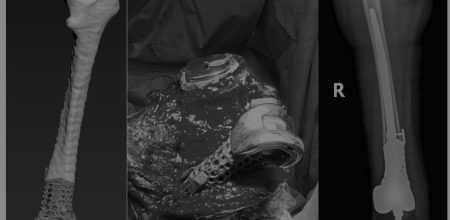ssues of Knee Joint Endoprosthetics in Megadefects Cases: Opportunities and Challenges Issues of Knee Joint Endoprosthetics in Mega-defects Cases: Opportunities and Challenges